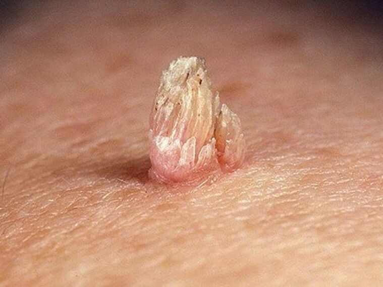 papilloma genital pada badan