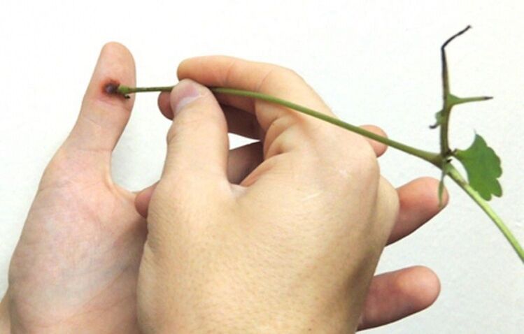 penyingkiran ketuat pada jari dengan jus herba celandine
